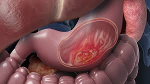 Stomach Cancer Treatment in Electronic City
